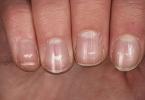 Проблемы с ногтями: о чем говорят и как им помочь Диагностика и лечение деформации ногтей